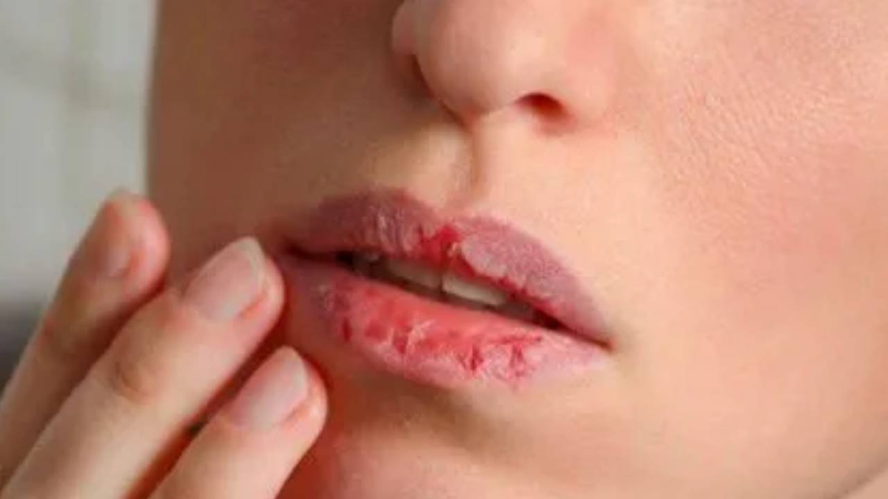 सर्दियों में ​फटे होंठ-एड़ियां की समस्या से राहत दिलाएंगे ये टिप्स, जल्द दिखेंगे फायदे