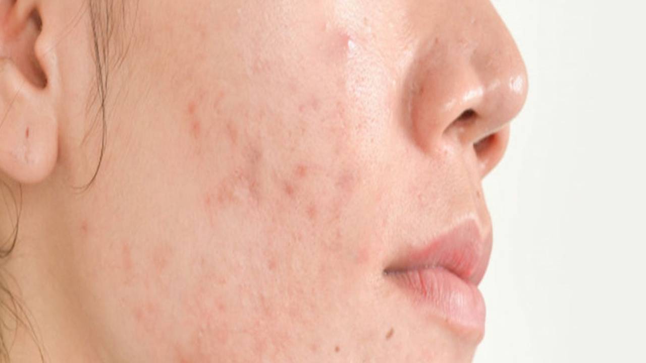​इन गलत आदतों की वजह से ठीक नहीं होते पिंपल्स, जानें इसका हल