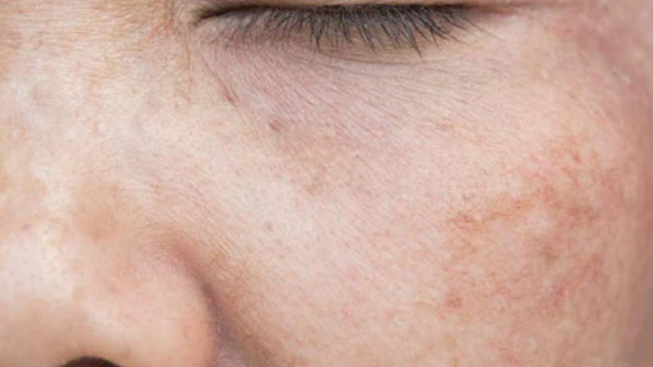​चेहरे के दाग-धब्बों और पिंपल्स की समस्या बढ़ा देगी 6 चीजें, त्वचा होगी खराब